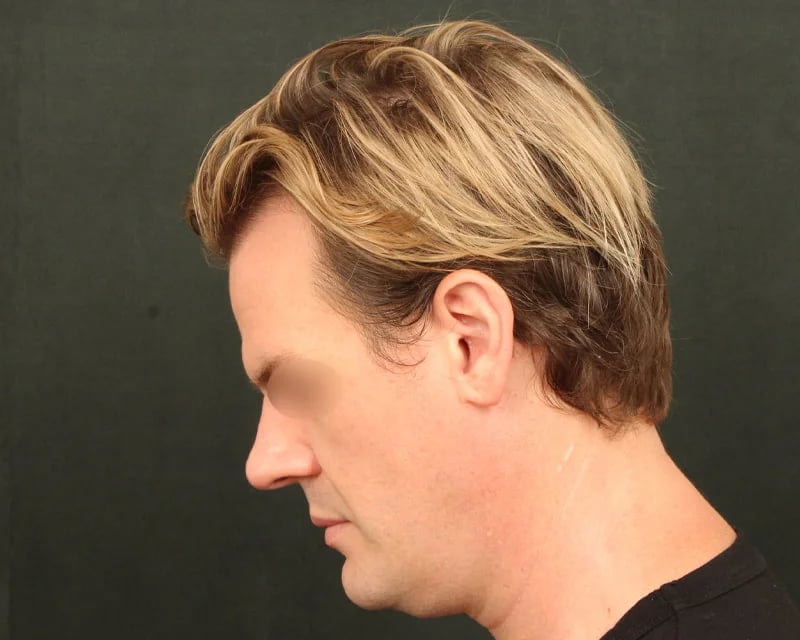 Neck Lift (Holiday Neck Lift®) Before & After Image