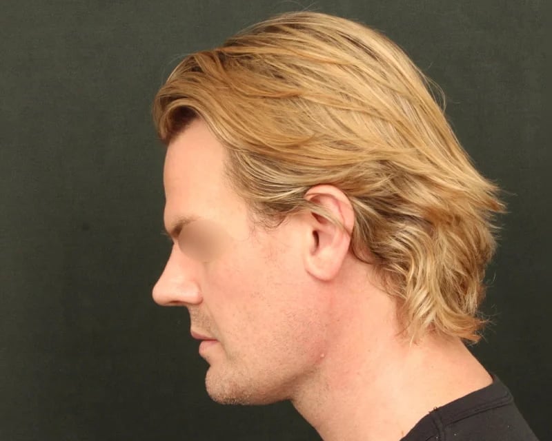Neck Lift (Holiday Neck Lift®) Before & After Image
