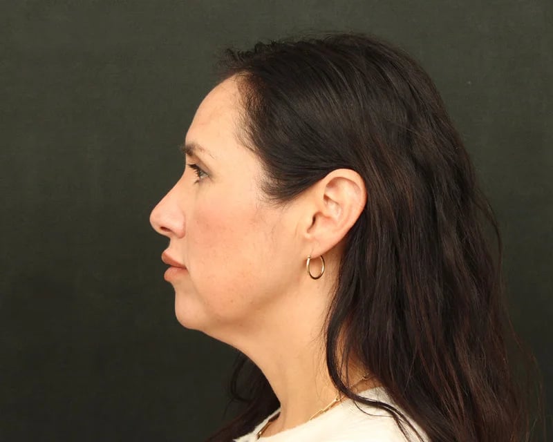 Patient Before Photo