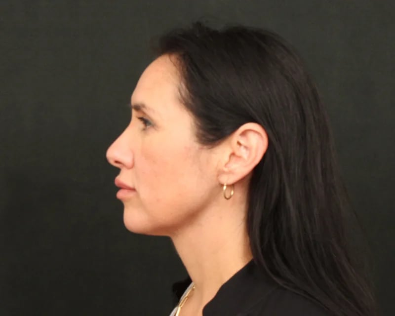 Patient After Photo