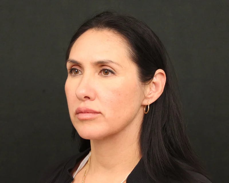 Patient After Photo