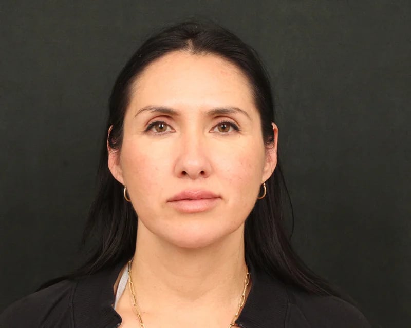 Patient After Photo