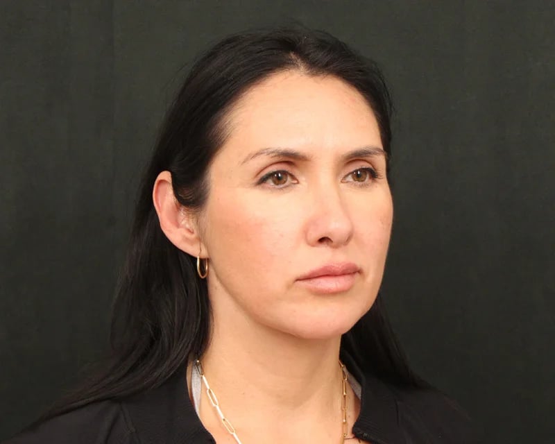 Neck Lift (Holiday Neck Lift®) Before & After Image
