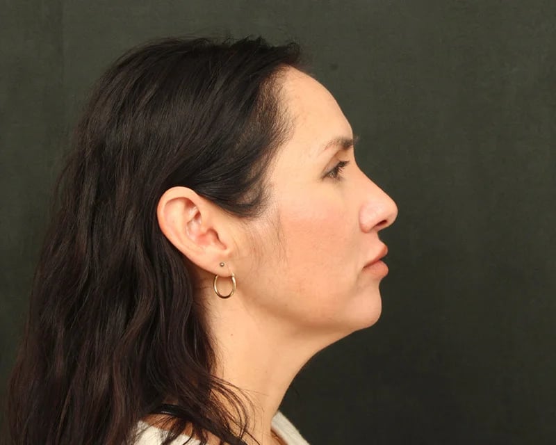 Neck Lift (Holiday Neck Lift®) Before & After Image