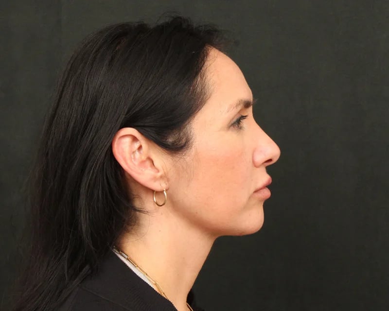 Neck Lift (Holiday Neck Lift®) Before & After Image