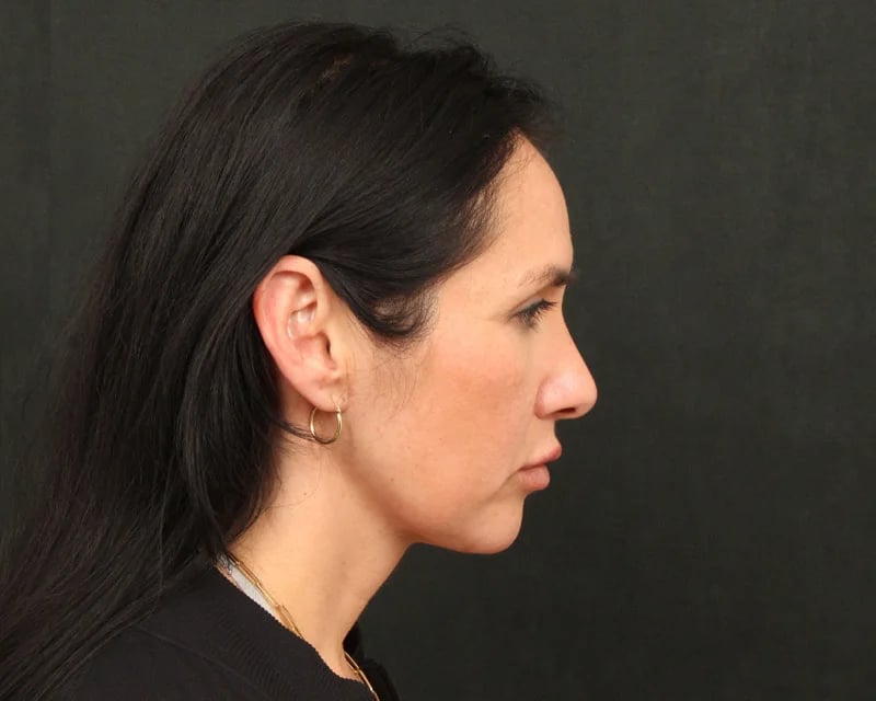 Patient After Photo