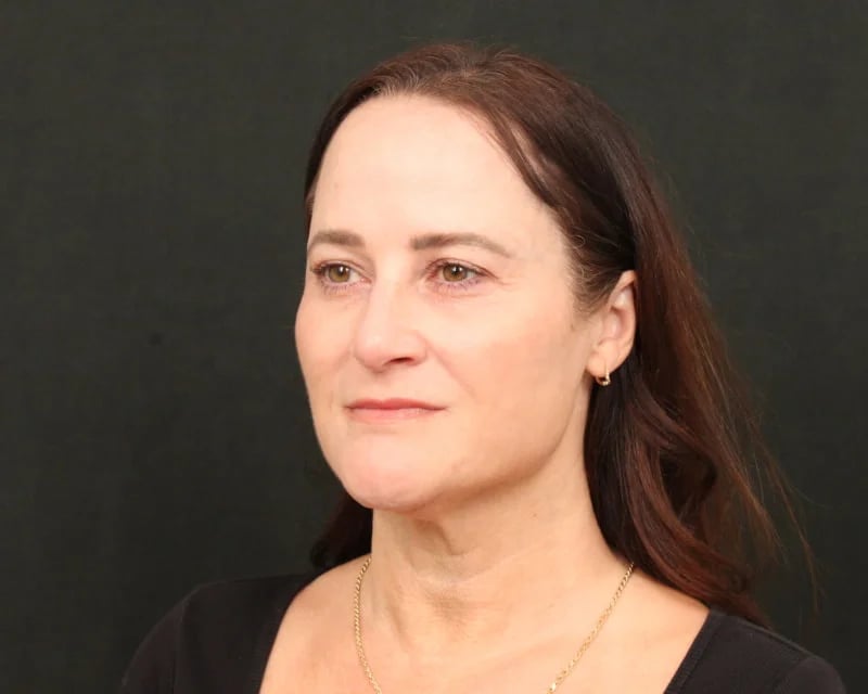 Neck Lift (Holiday Neck Lift®) Before & After Image