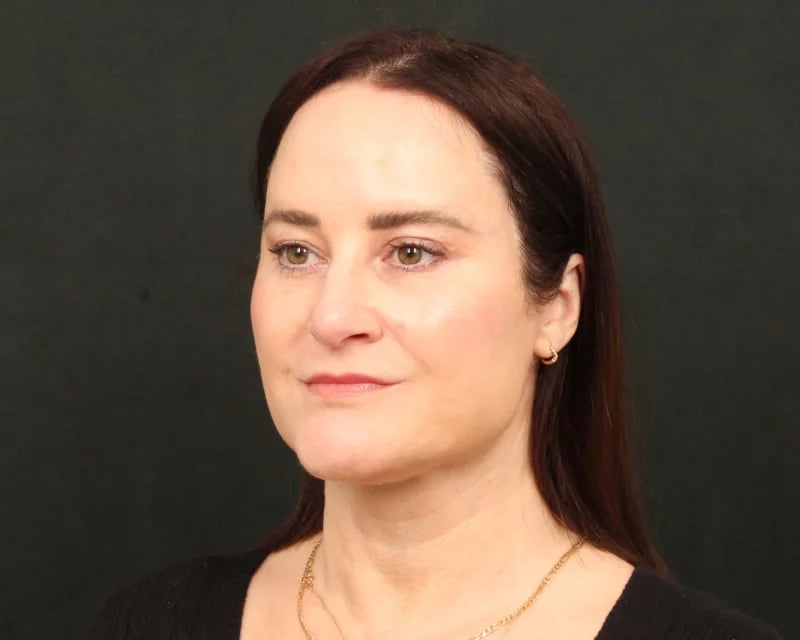 Neck Lift (Holiday Neck Lift®) Before & After Image