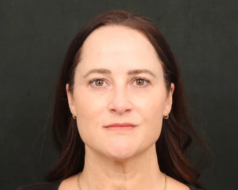 Neck Lift (Holiday Neck Lift®) Before & After Image