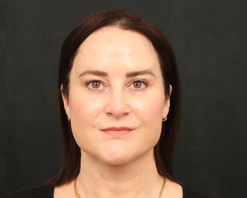 Neck Lift (Holiday Neck Lift®) Before & After Image