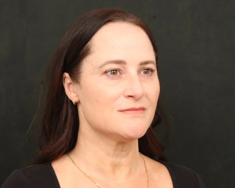 Neck Lift (Holiday Neck Lift®) Before & After Image