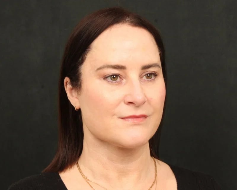 Neck Lift (Holiday Neck Lift®) Before & After Image