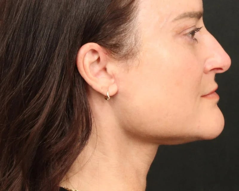 Neck Lift (Holiday Neck Lift®) Before & After Image