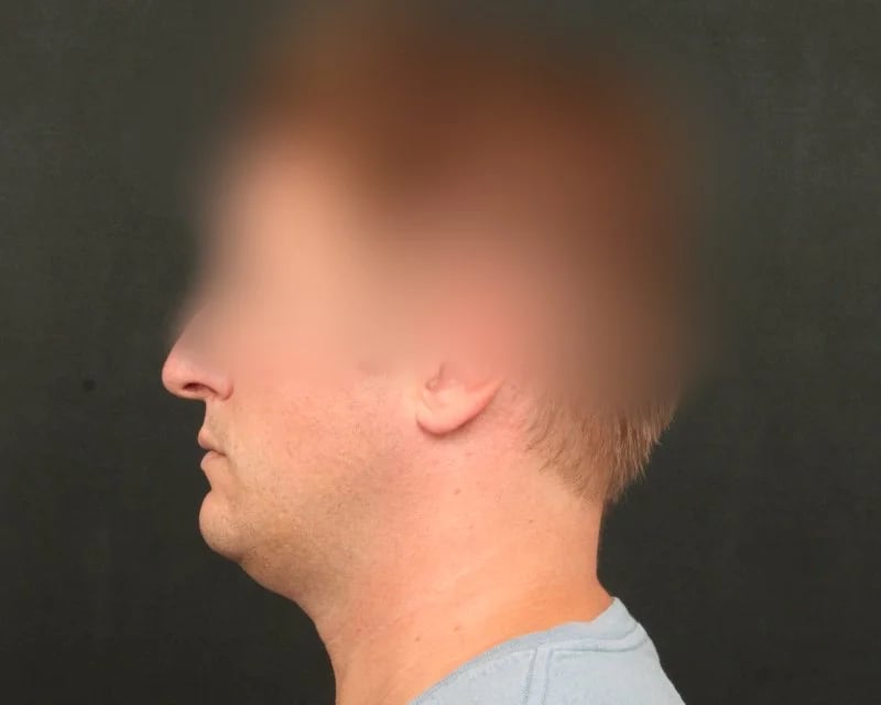 Neck Lift (Holiday Neck Lift®) Before & After Image