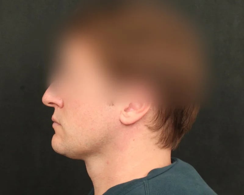 Neck Lift (Holiday Neck Lift®) Before & After Image