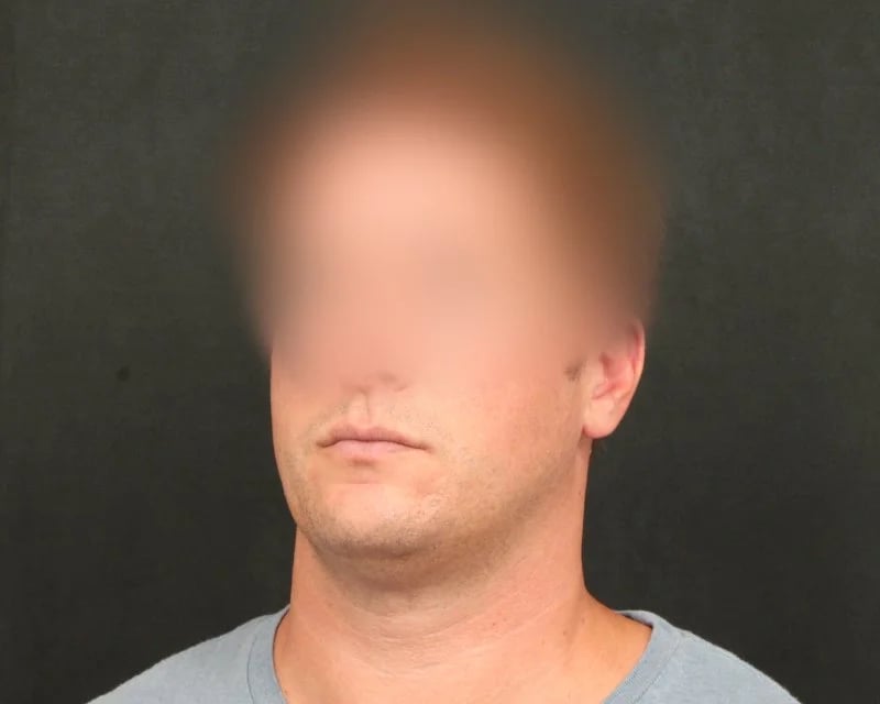 Neck Lift (Holiday Neck Lift®) Before & After Image