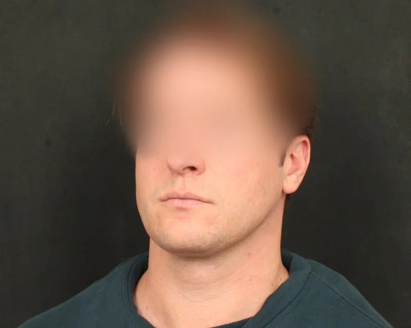 Neck Lift (Holiday Neck Lift®) Before & After Image