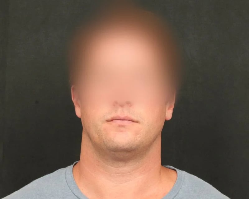 Neck Lift (Holiday Neck Lift®) Before & After Image