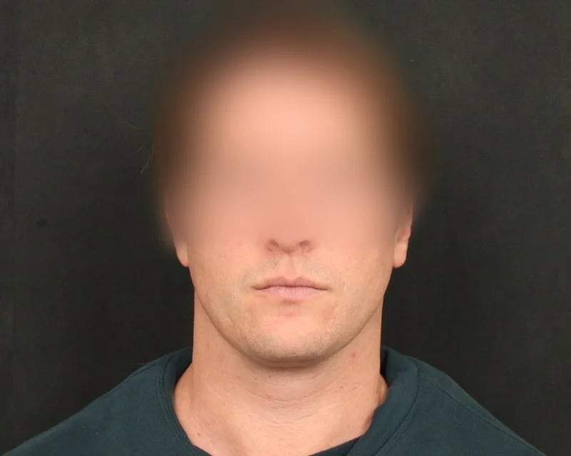 Neck Lift (Holiday Neck Lift®) Before & After Image