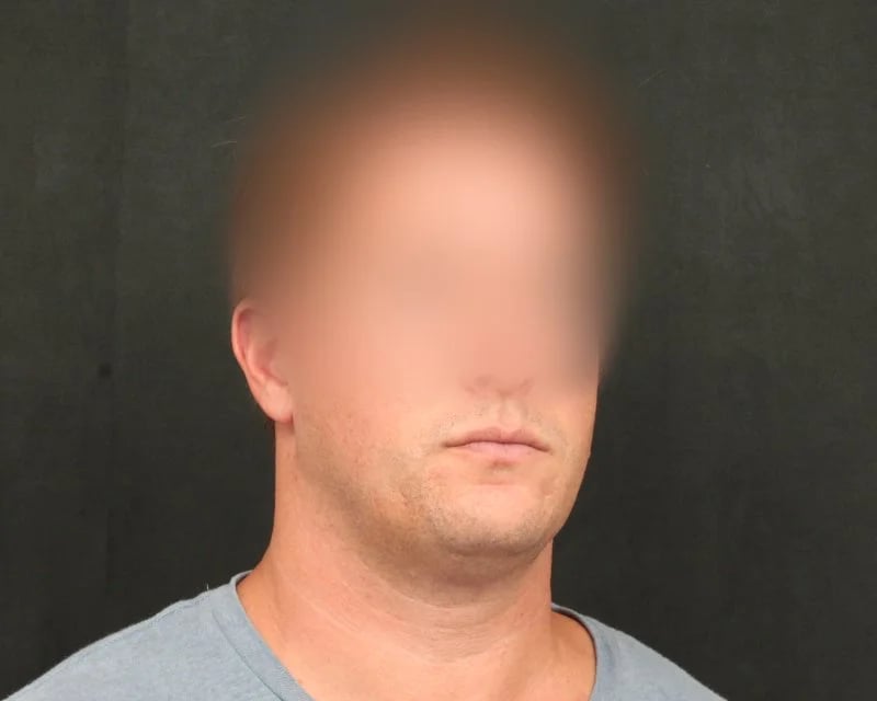Neck Lift (Holiday Neck Lift®) Before & After Image
