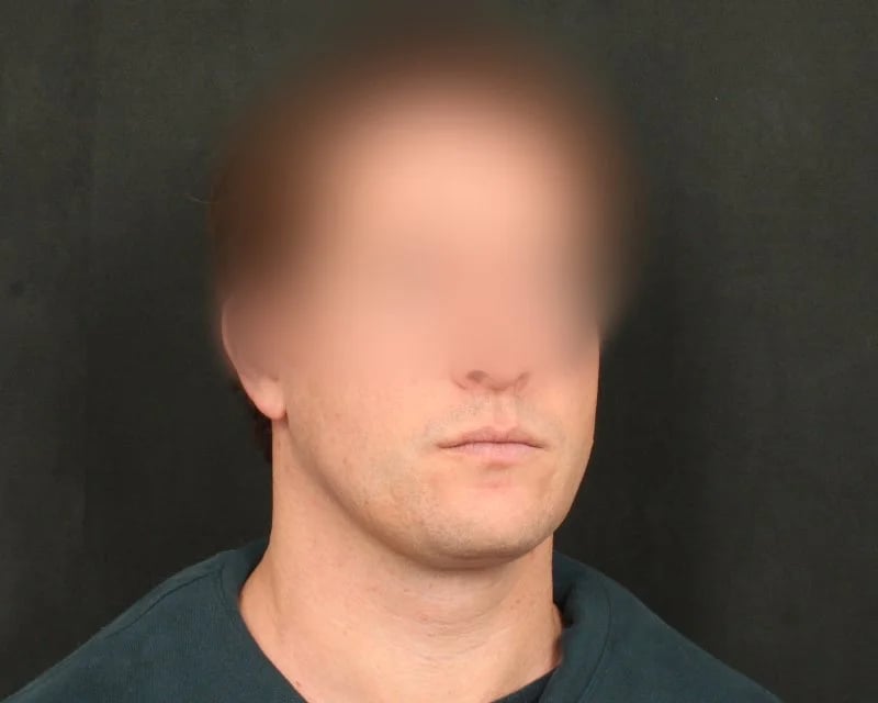 Neck Lift (Holiday Neck Lift®) Before & After Image