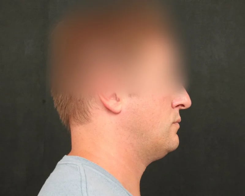 Neck Lift (Holiday Neck Lift®) Before & After Image