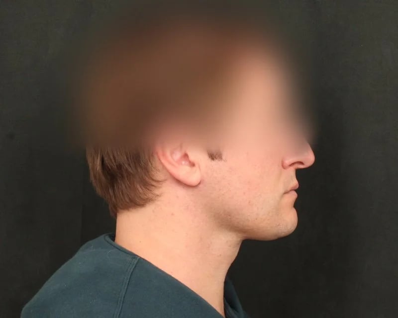 Neck Lift (Holiday Neck Lift®) Before & After Image