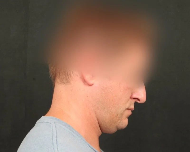 Neck Lift (Holiday Neck Lift®) Before & After Image