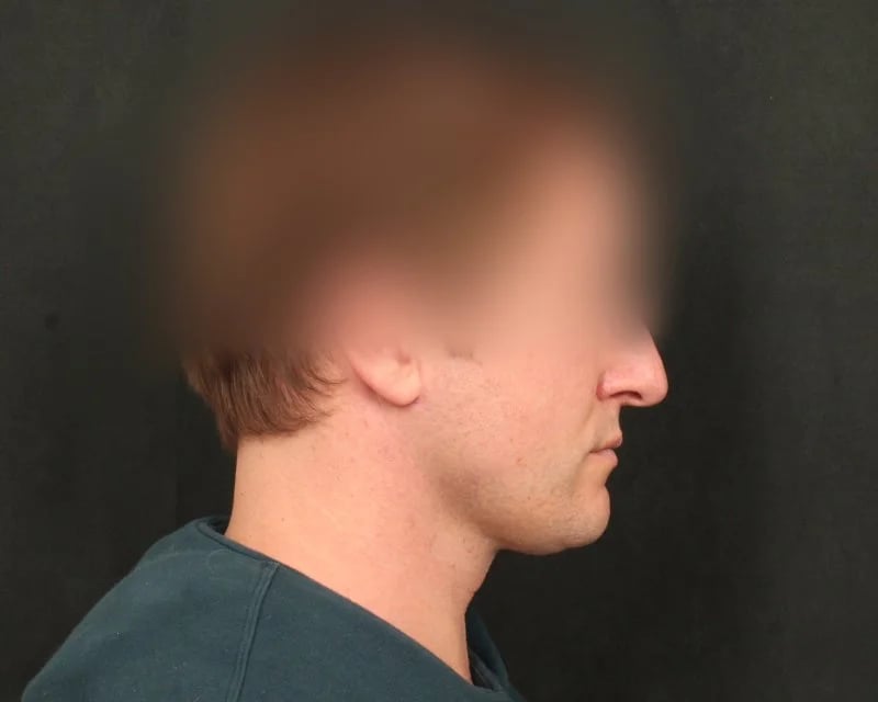 Neck Lift (Holiday Neck Lift®) Before & After Image