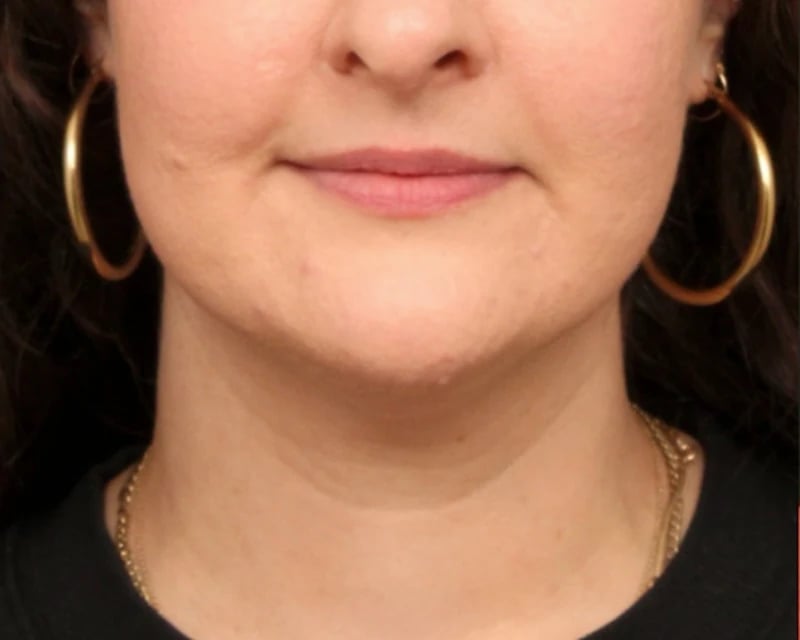 Neck Lift (Holiday Neck Lift®) Before & After Image