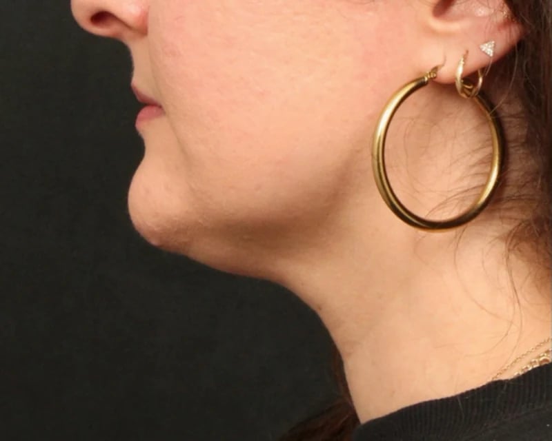 Neck Lift (Holiday Neck Lift®) Before & After Image