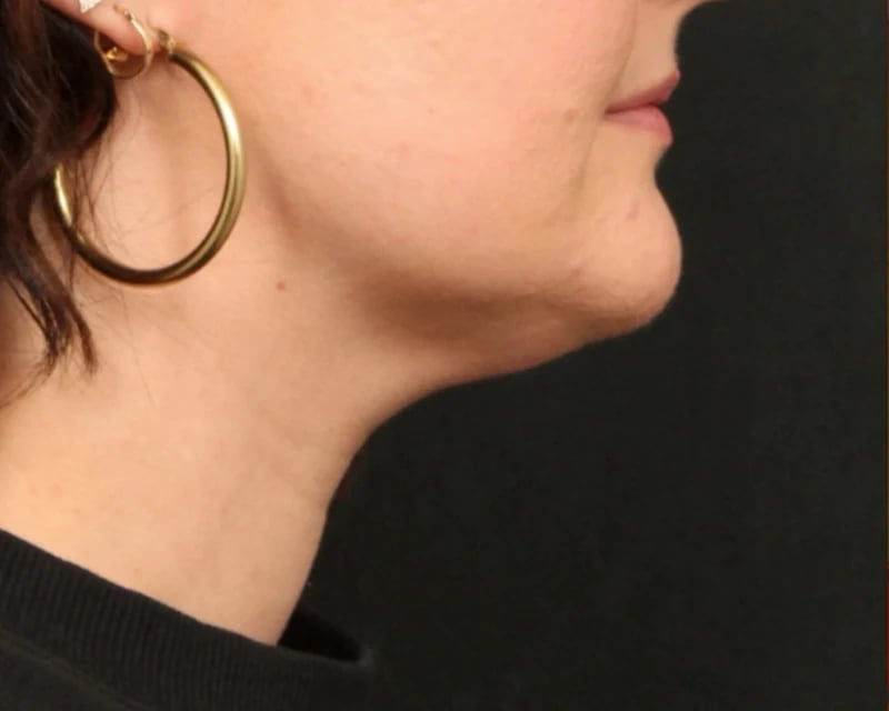 Neck Lift (Holiday Neck Lift®) Before & After Image