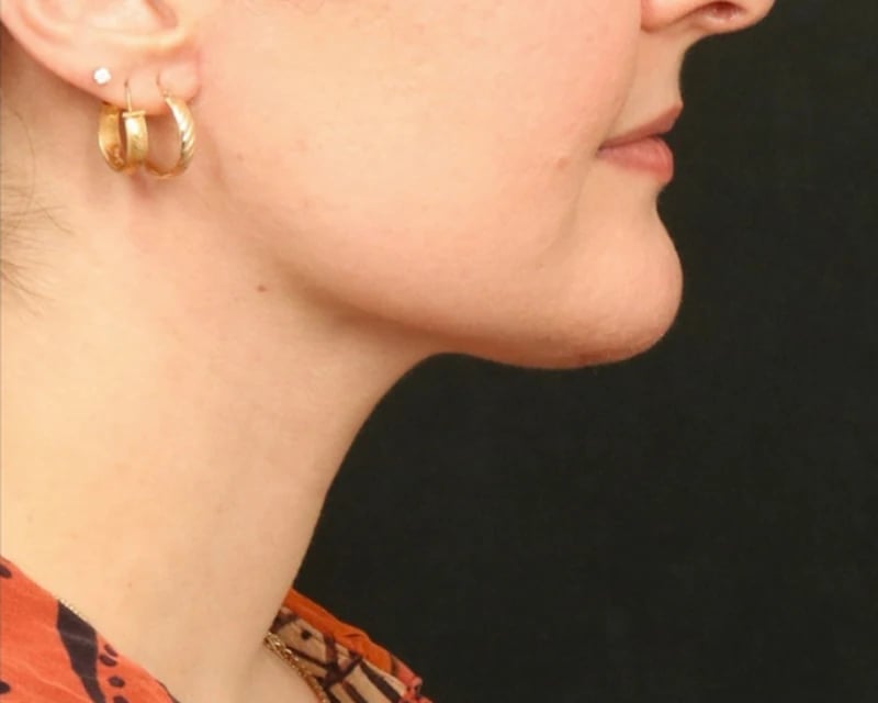 Neck Lift (Holiday Neck Lift®) Before & After Image