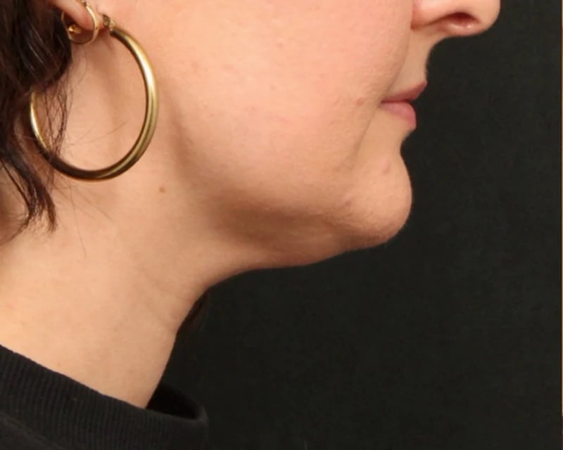 Neck Lift (Holiday Neck Lift®) Before & After Image