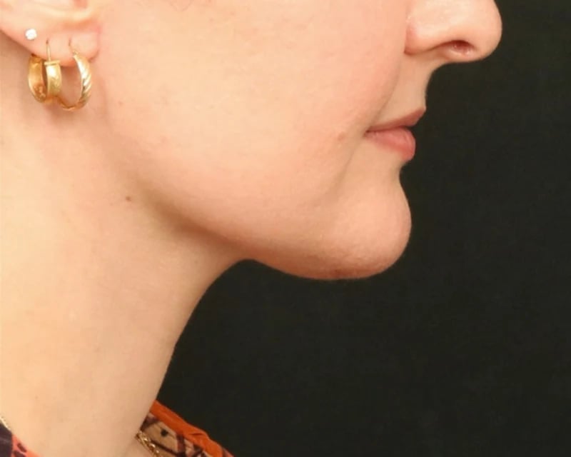 Neck Lift (Holiday Neck Lift®) Before & After Image