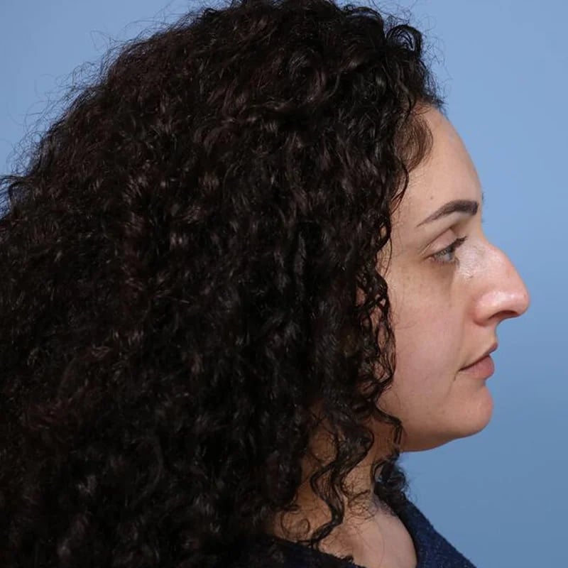 Rhinoplasty Before & After Image
