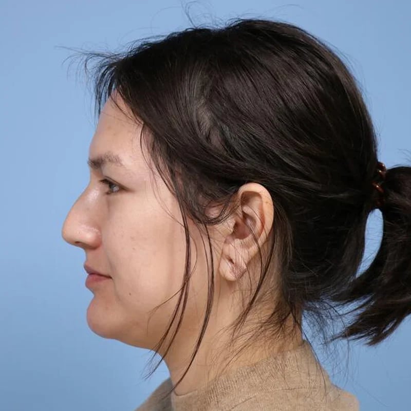 Rhinoplasty Before & After Image
