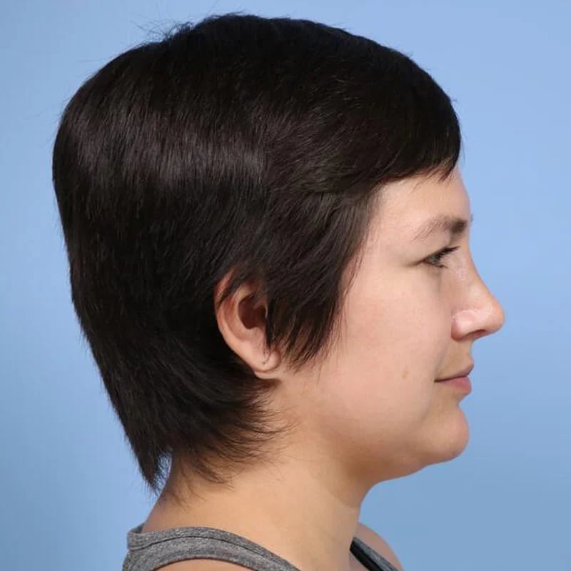 Rhinoplasty Before & After Image
