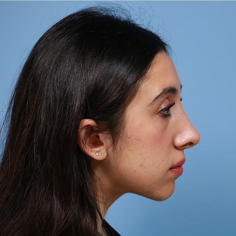 Rhinoplasty Before & After Image