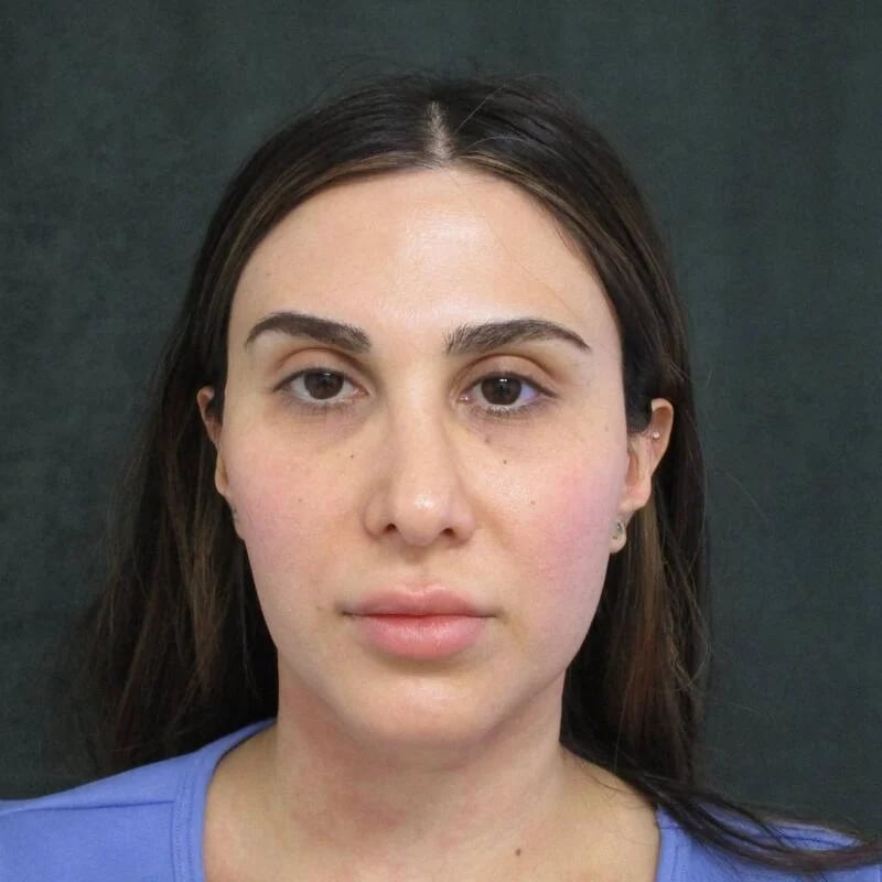 Rhinoplasty Before & After Image