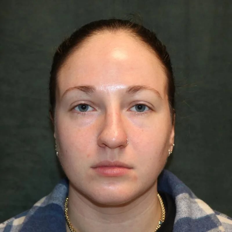 Rhinoplasty Before & After Image