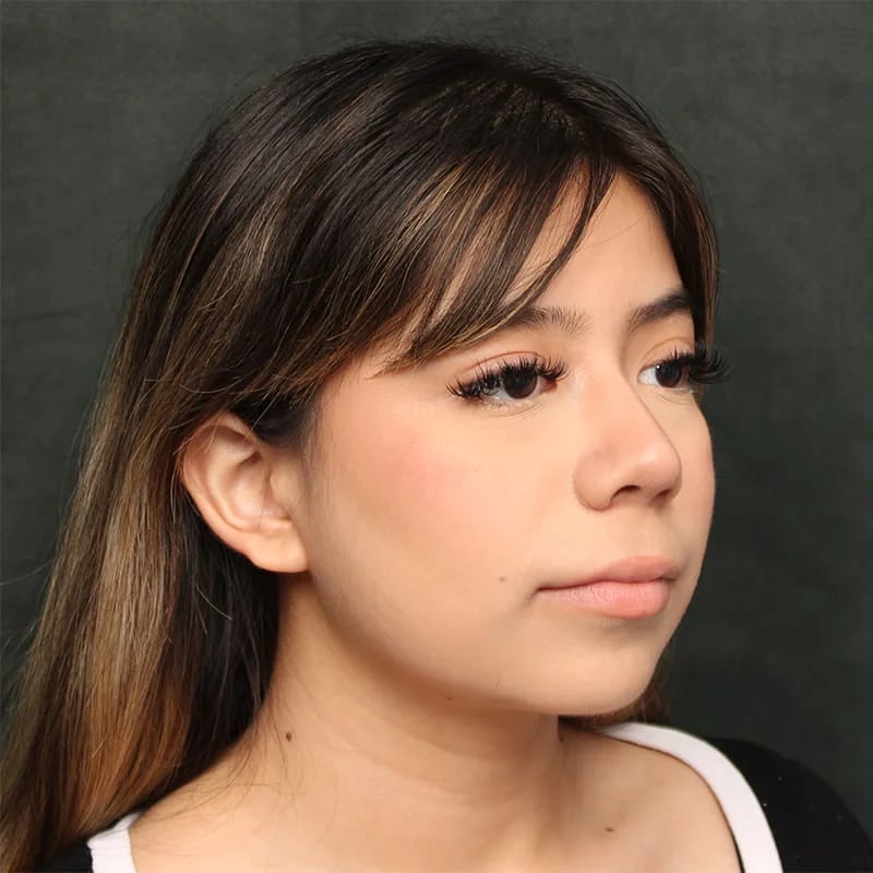 Rhinoplasty Before & After Image