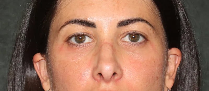 Upper Blepharoplasty Before & After Image