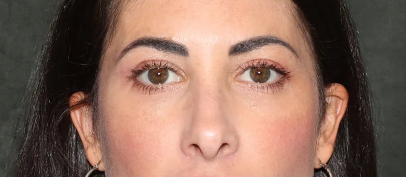 Upper Blepharoplasty Before & After Image