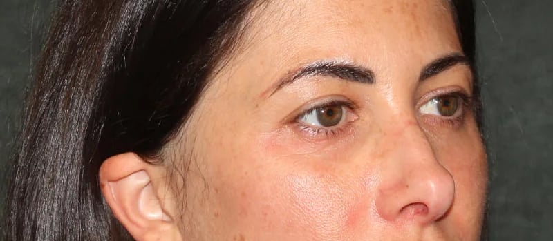 Upper Blepharoplasty Before & After Image