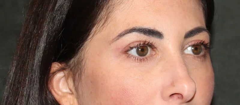 Upper Blepharoplasty Before & After Image