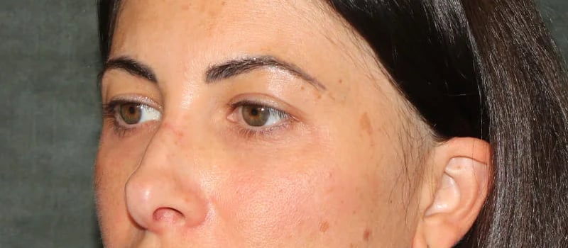 Upper Blepharoplasty Before & After Image