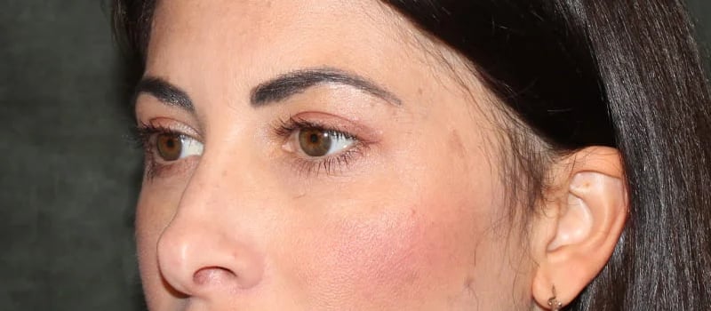 Upper Blepharoplasty Before & After Image