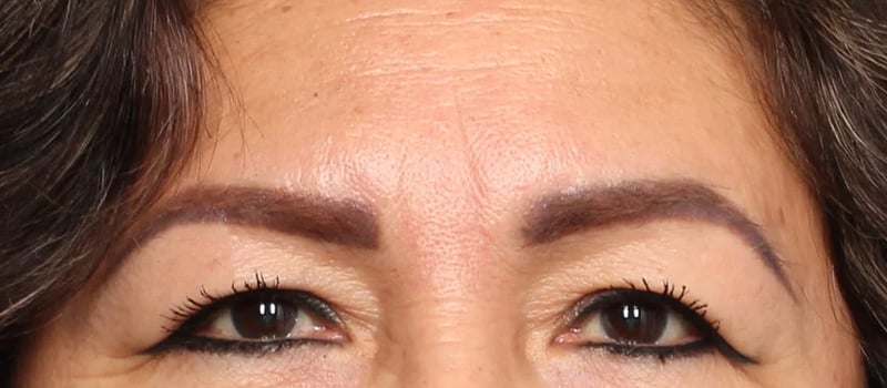 Upper Blepharoplasty Before & After Image