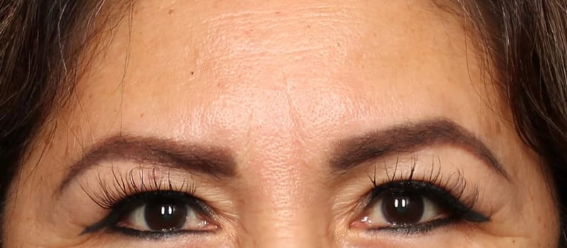 Upper Blepharoplasty Before & After Image